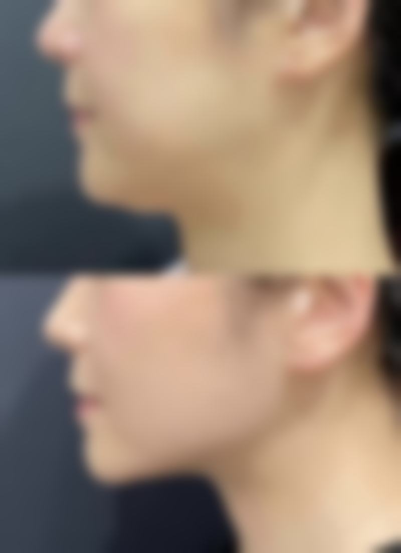 嘴唇有点厚怎么弄薄