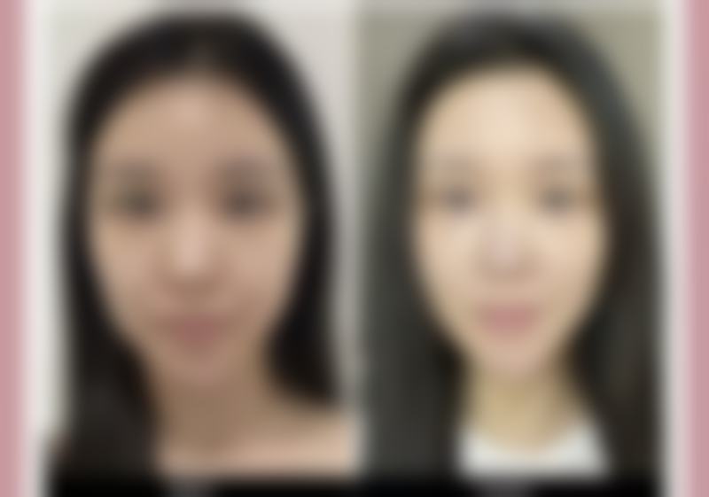 秃顶头发可以种植吗(男女有别)