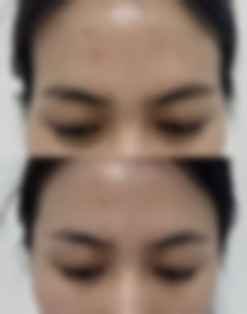 嘴唇太厚变薄小妙招