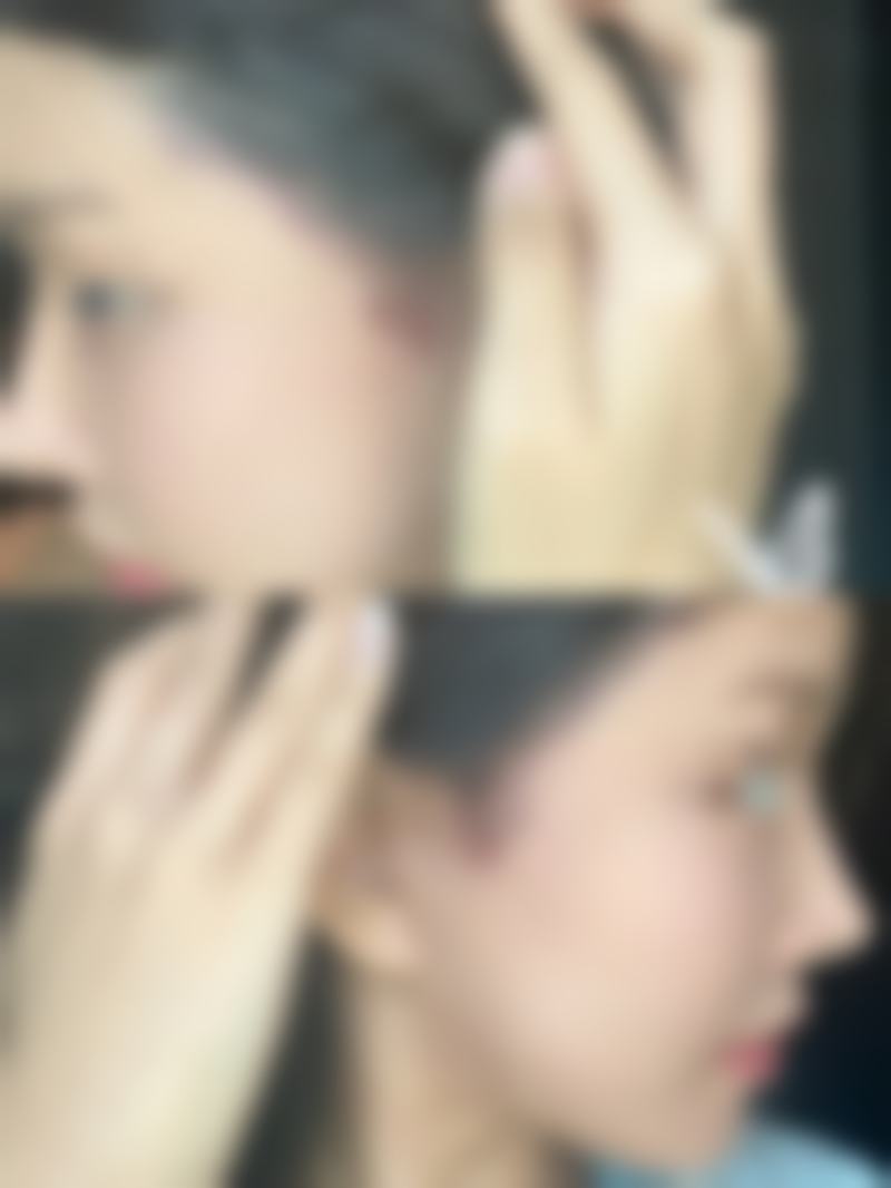 打完瘦脸针后嘴巴歪了