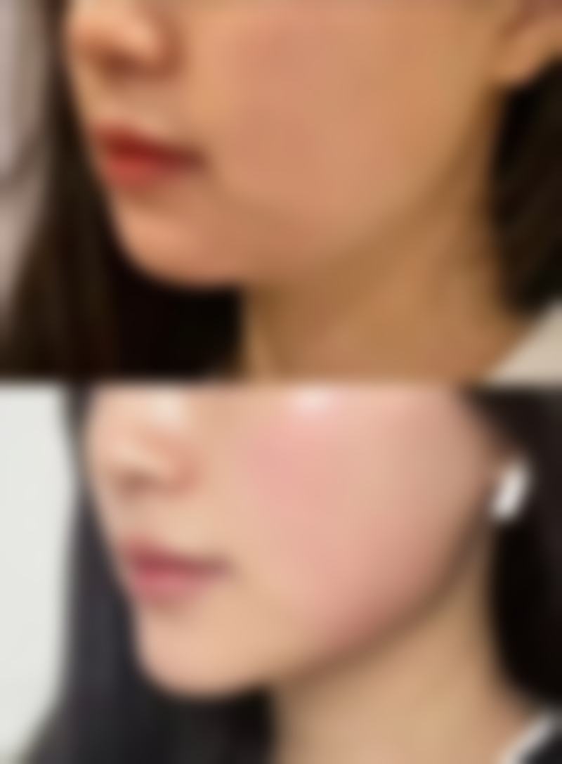 种植发际线要几个小时