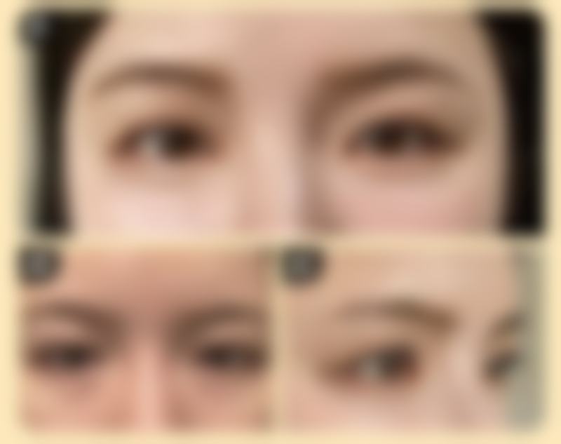 种植发际线几天可以消肿