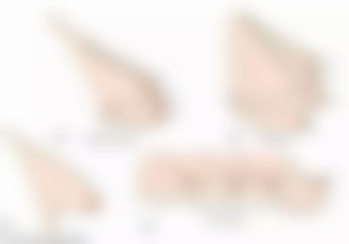 瘦脸针要打几次定型