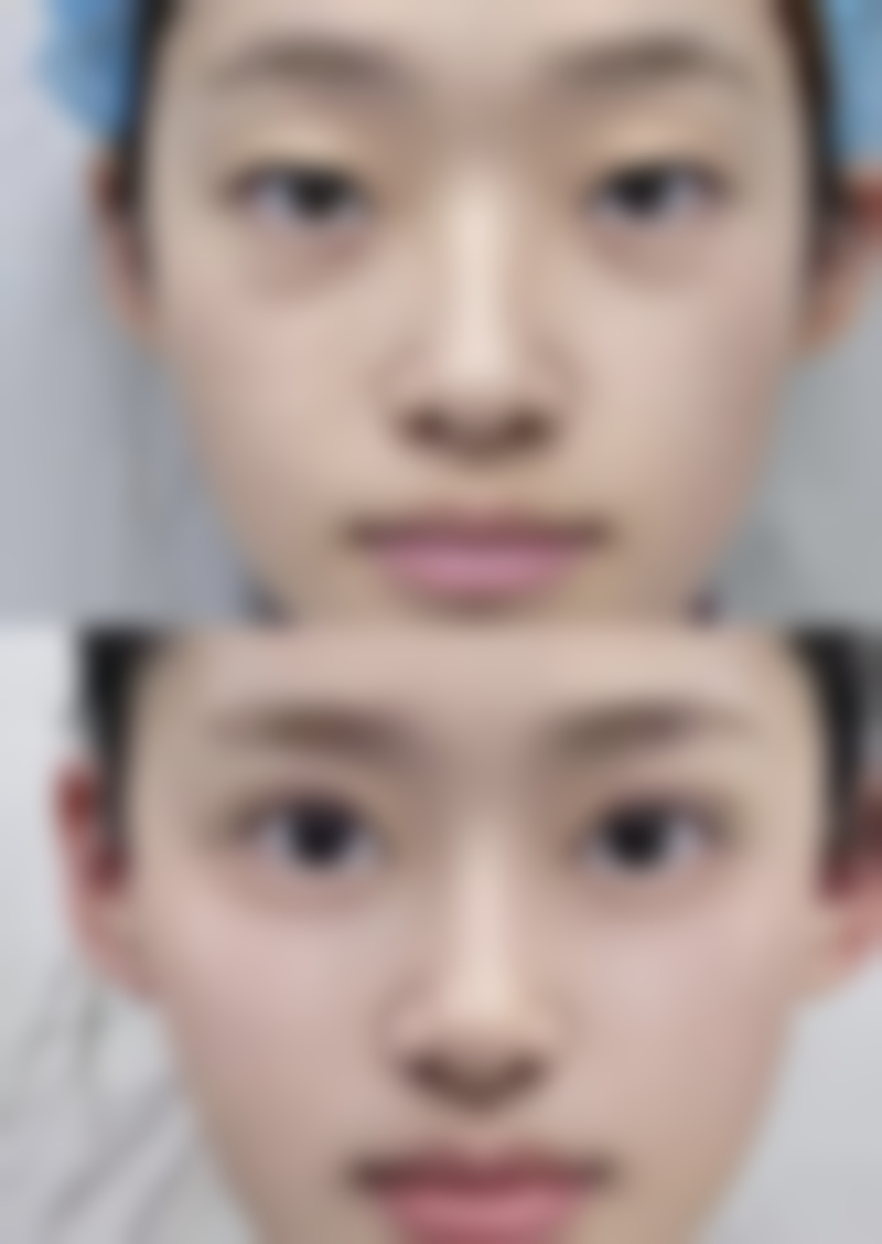 打完瘦脸针多久可以平躺