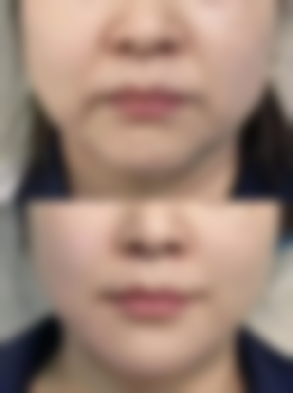 打完瘦脸针多久出现效果？专家揭秘：一般7 - 15天初见成效，30天左右效果最佳！ 