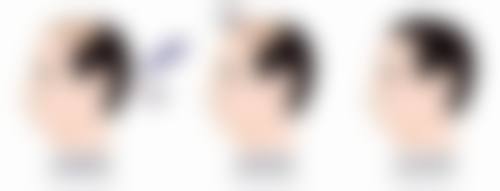 判断是否适合瘦脸针的小方法