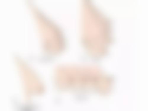 国字脸打瘦脸针图片前后对比