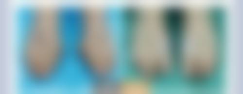 打玻尿酸除皱需要多少钱