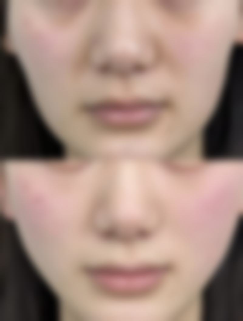 国字脸可以打瘦脸针吗？可以瘦脸吗？