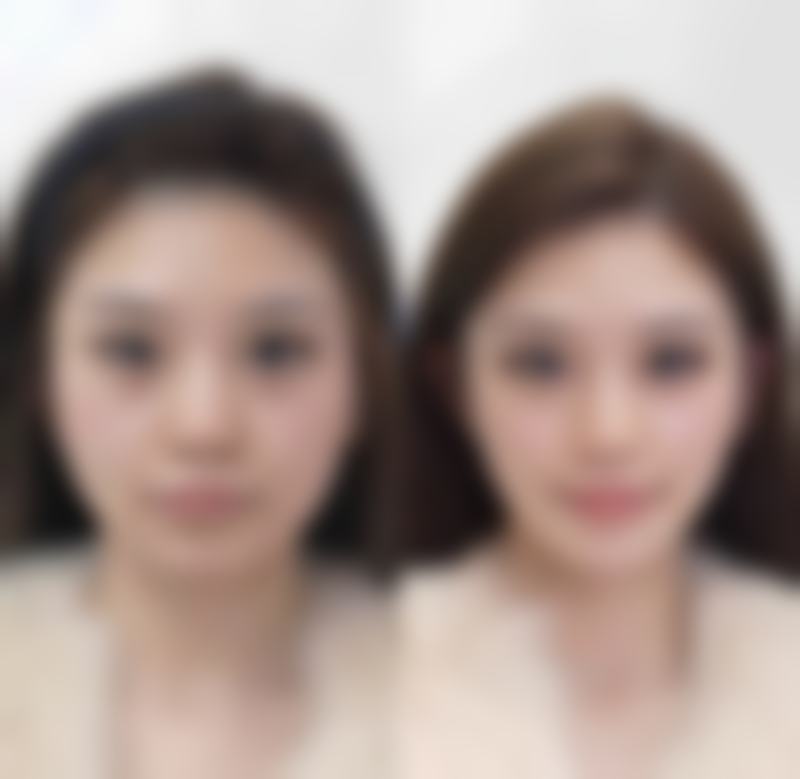 儿童嘴唇上翘什么原因