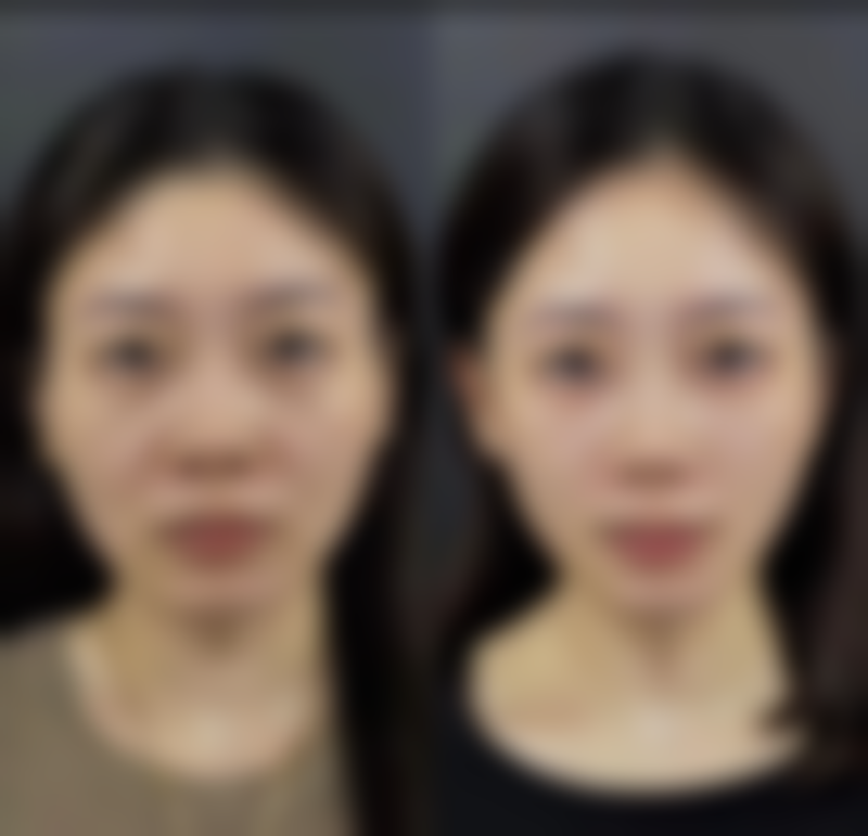 线提升提升:提拉紧致有妙招