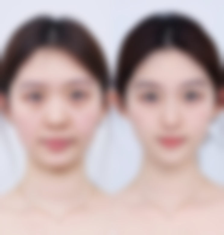 自体脂肪移植:用自己的脂肪变得更美