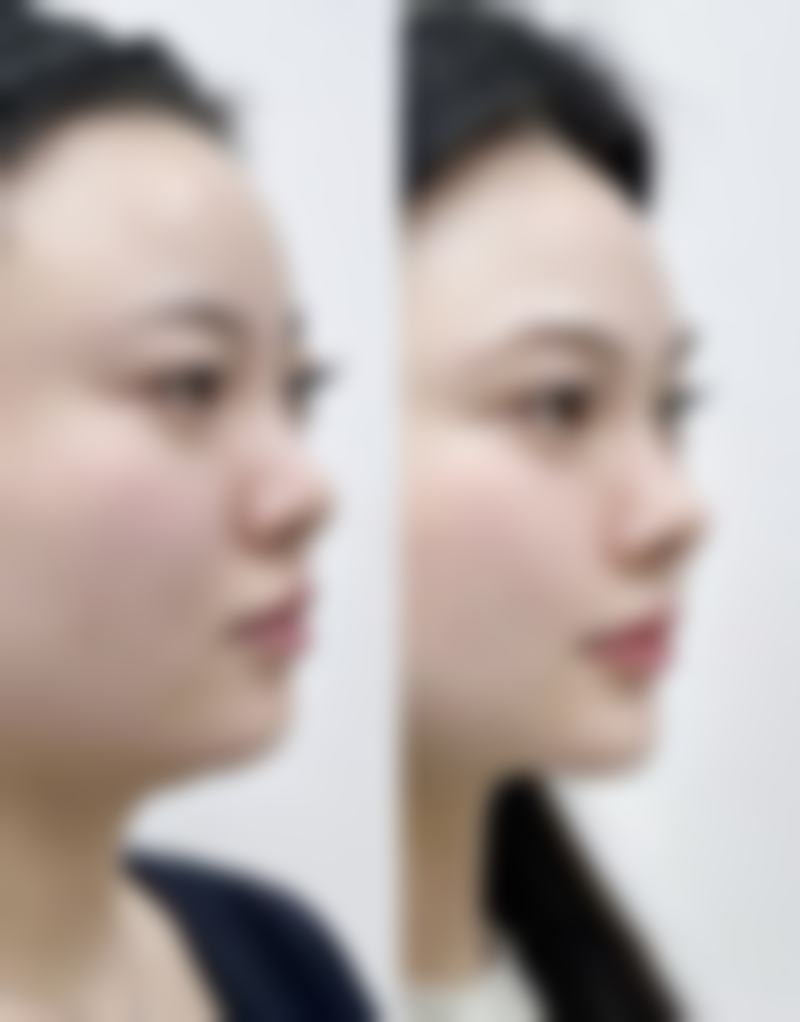 瘦脸针打多久成效更明显