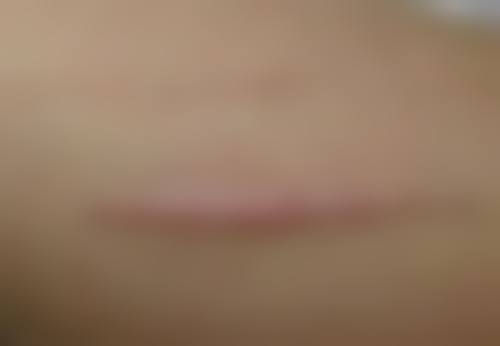 瘦脸针的危害和副作用