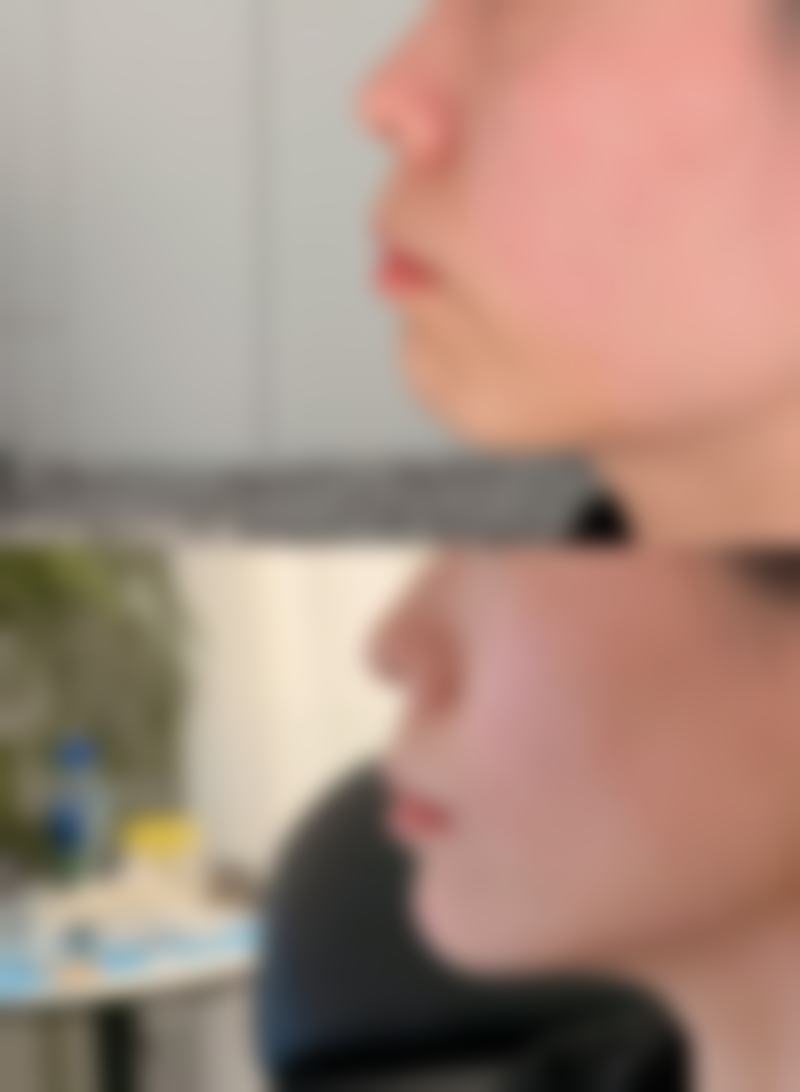 瘦脸针打完多久见效