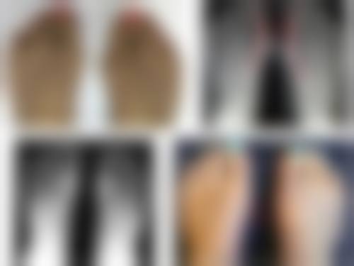 咬肌大打瘦脸针成效明显吗