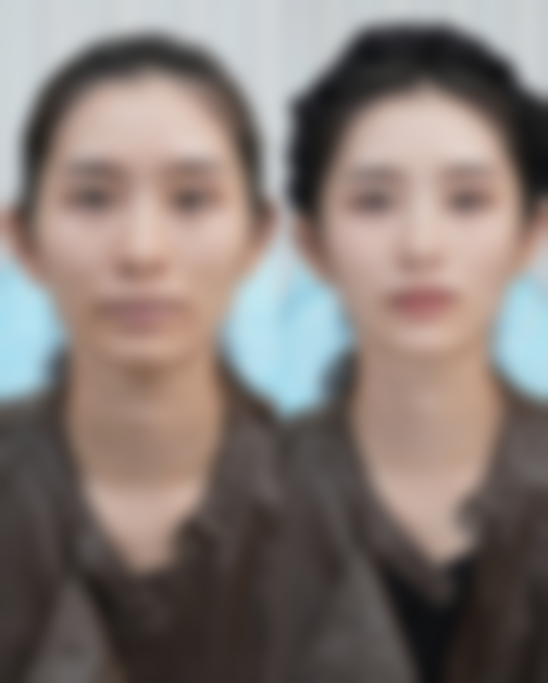 高田美白针打法图解