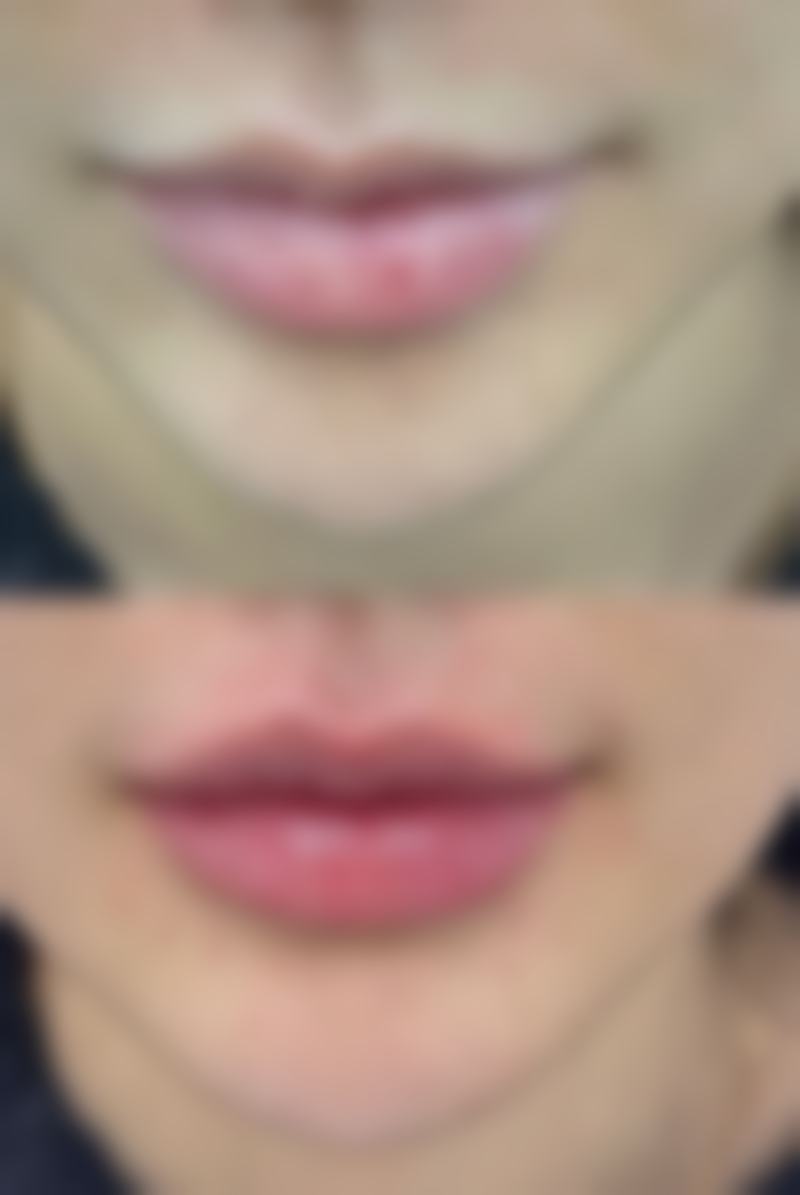 种植头发的危害和后遗症