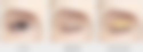 注射玻尿酸能维持多久?