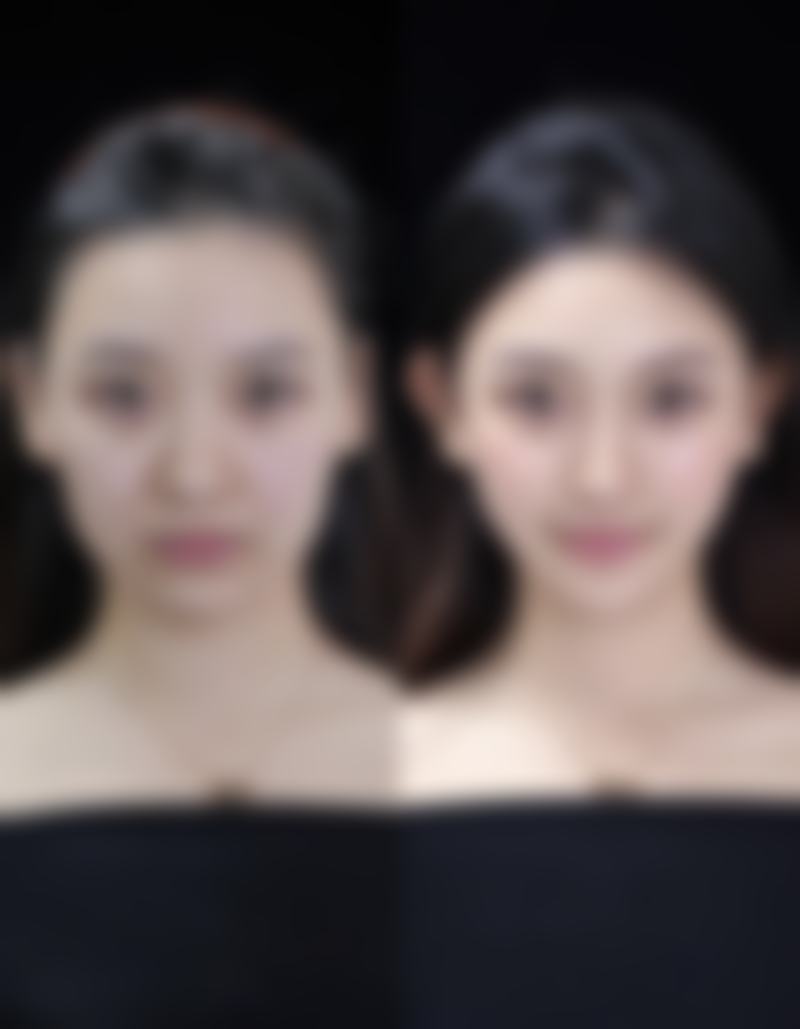 丰太阳穴需要多少支玻尿酸?