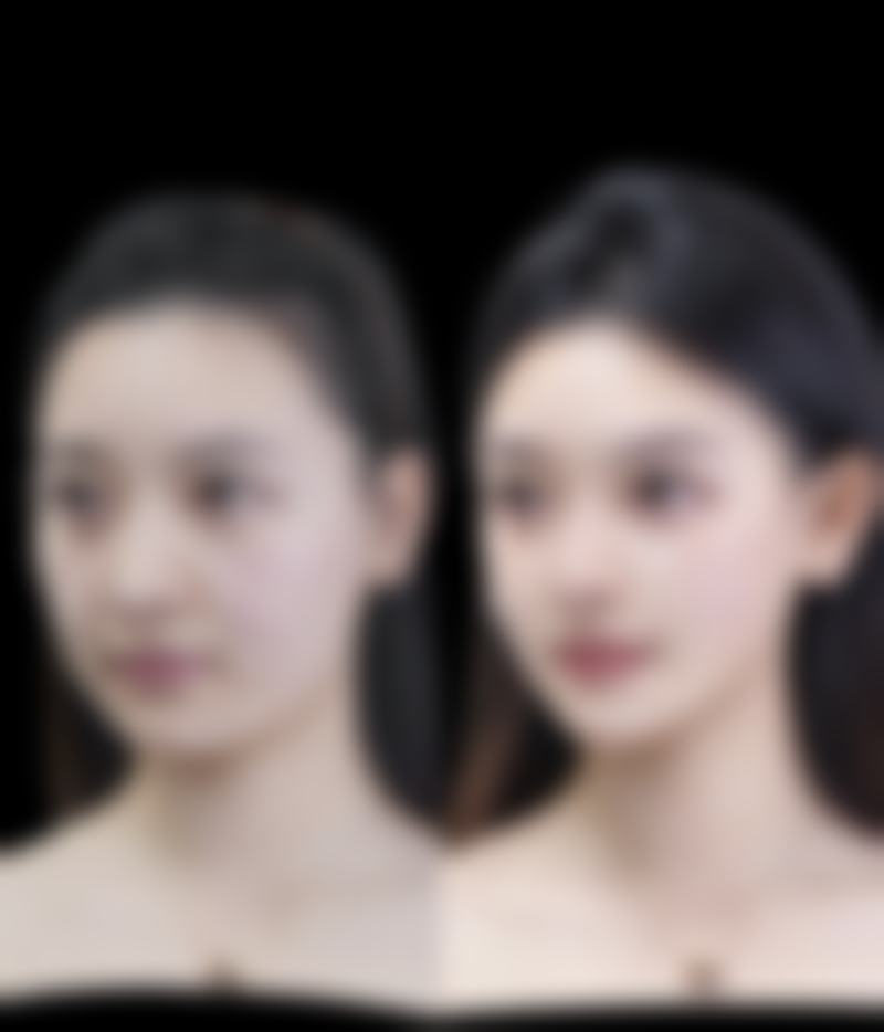 注射瘦脸针的后遗症