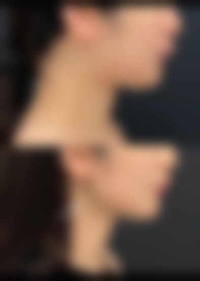 注射玻尿酸丰胸全过程