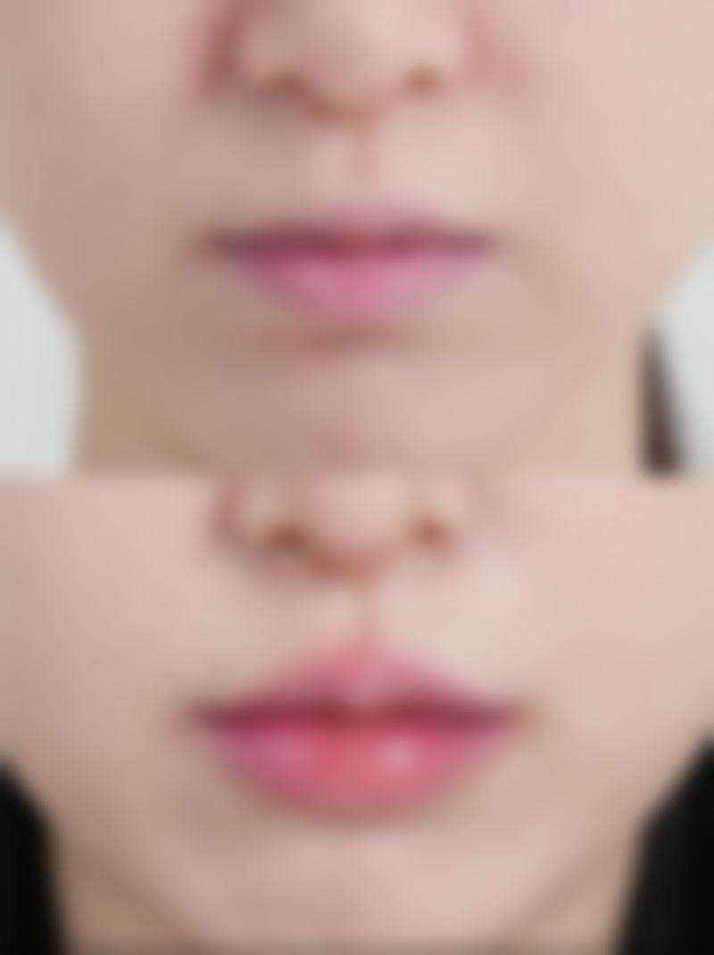 肉毒素替代疗法