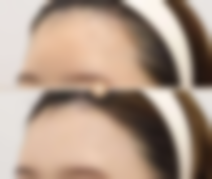 打了瘦脸针为什么没有酸疼或酸胀感