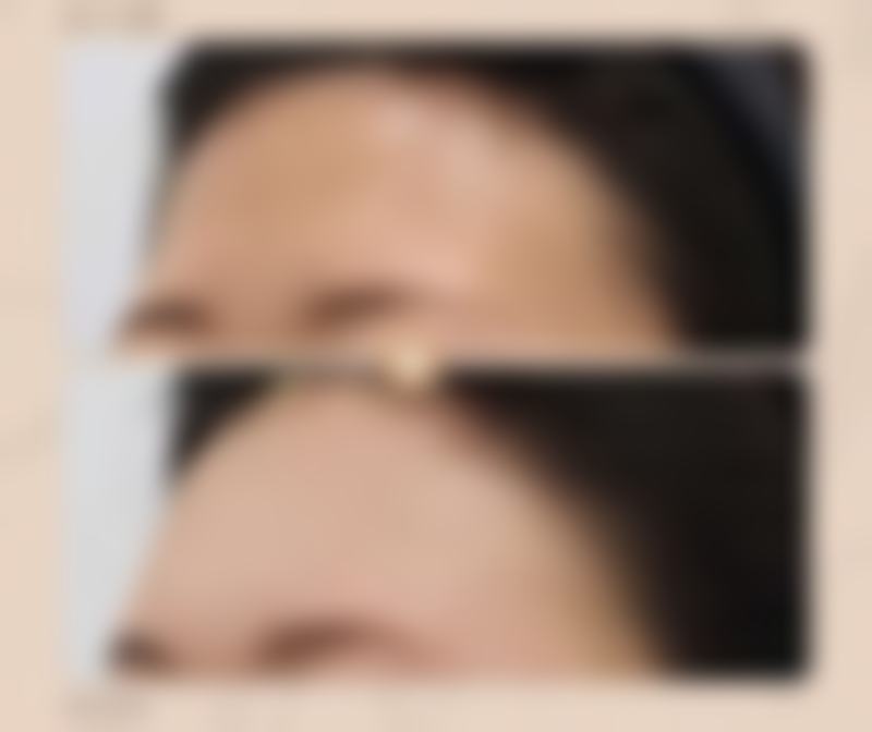 咬肌大不想打瘦脸针怎么能消