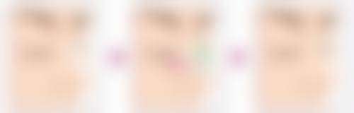 瘦脸针的其他注意事项和风险提示