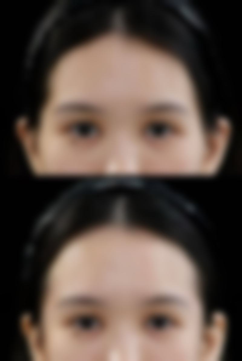 打过瘦脸针没有酸胀感觉的原因分析