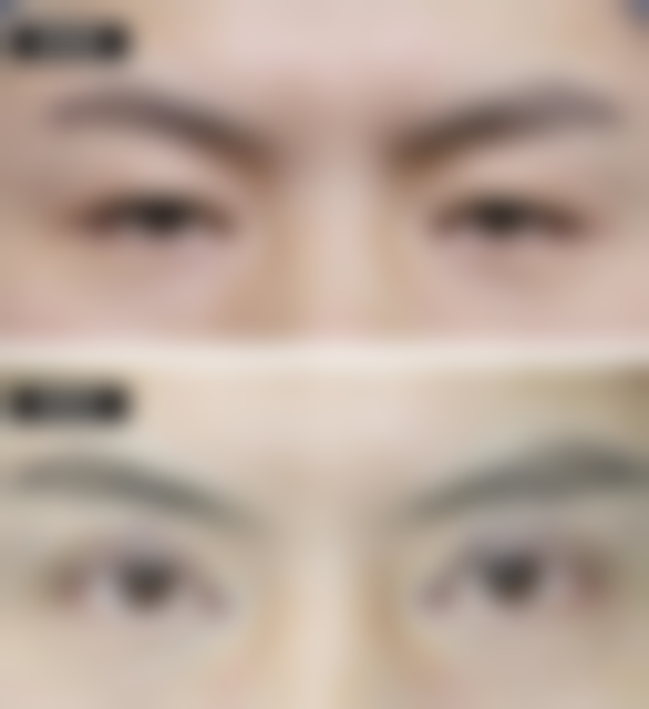 打了消炎针后多久可以打肉毒