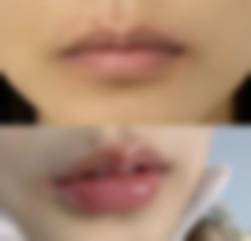 脸上有皱纹打除皱针好不好？揭秘打除皱针3大好处，让你50岁也能拥有30岁的紧致肌肤！ 