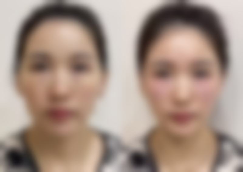 脸上有皱纹怎么办怎么保养