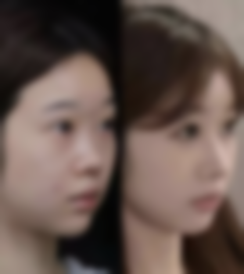 哪些情况适合打瘦脸针