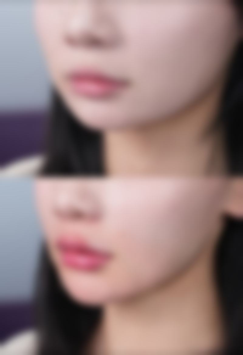 怎样会影响瘦脸针的成效