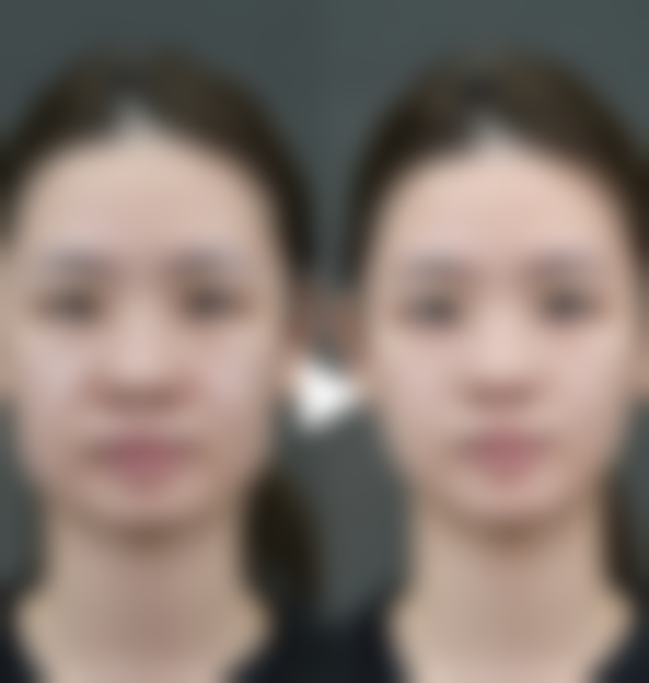 嘴唇薄可以做m唇吗？权威解答：薄唇做m唇的可行性、效果及3大关键注意事项揭秘！ 