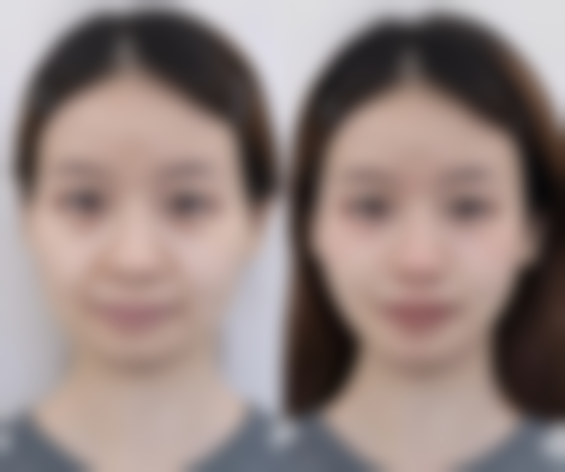 嘴巴下巴突出怎么矫正？掌握 3 种医美矫正方法，让你告别凸嘴，重塑精致侧颜！ 