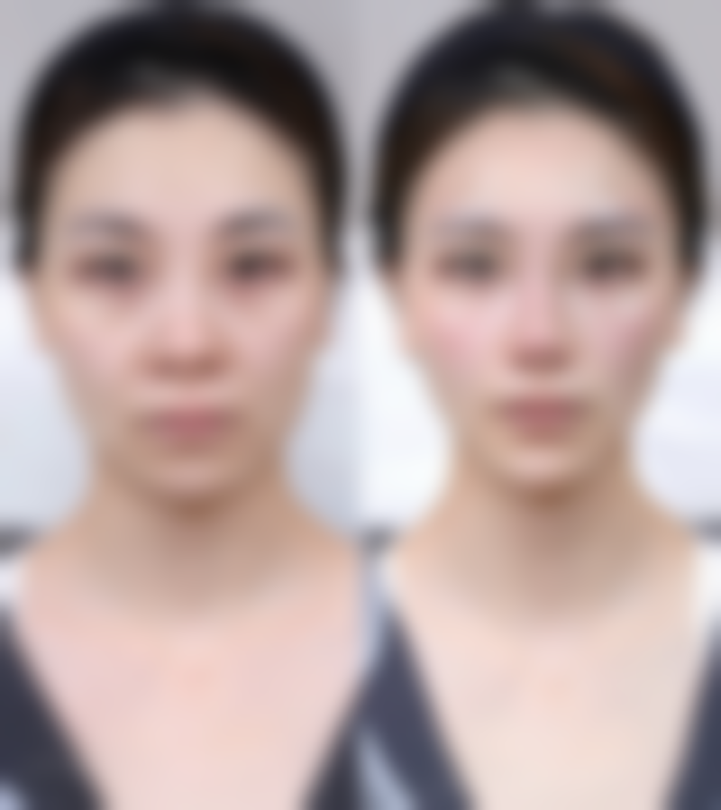 45岁可以打瘦脸针吗？答案是肯定的！权威解读45岁打瘦脸针的可行性、效果及注意事项 