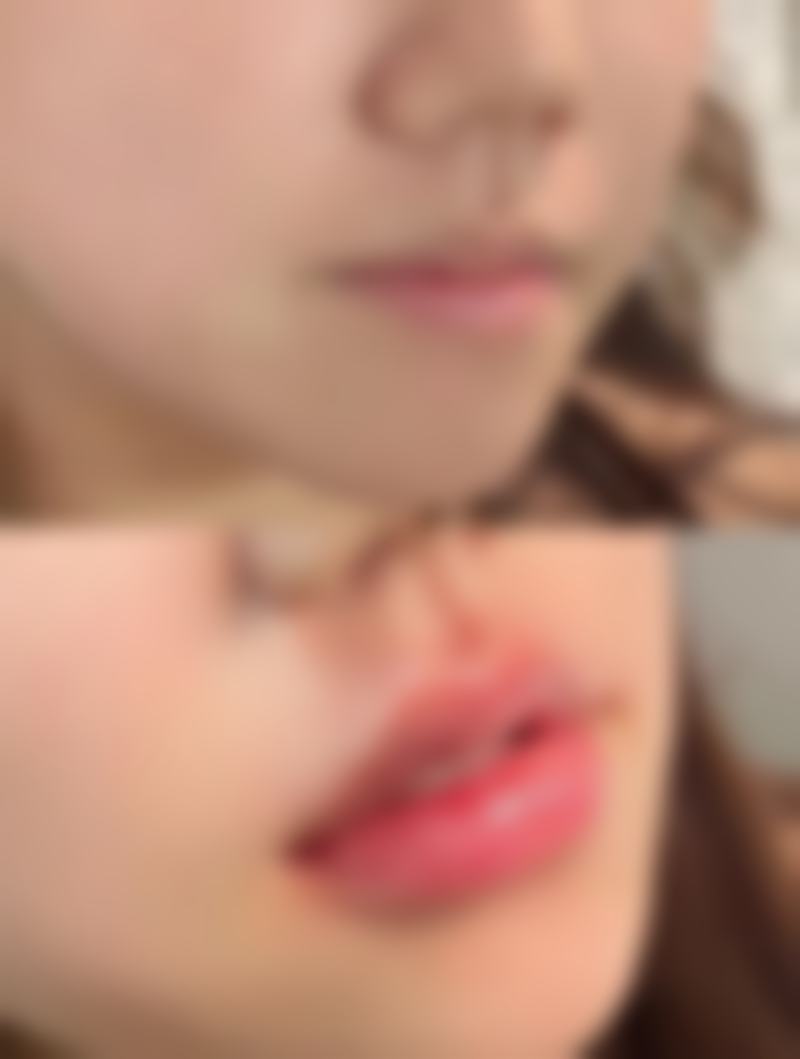 瘦脸针打多久能看出来成效