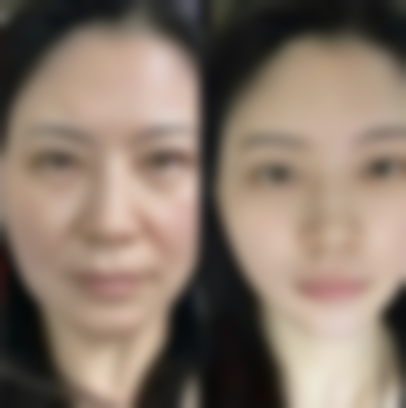 瘦脸针的价格及注意事项