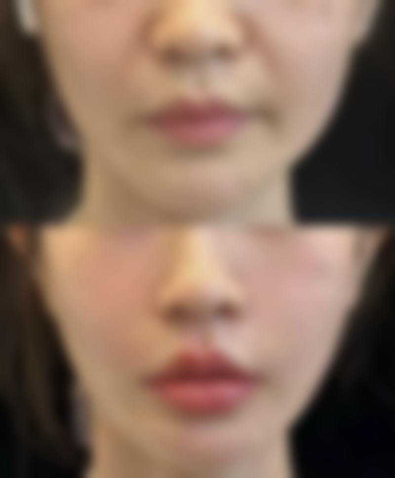 下巴整形哪种方法好一点