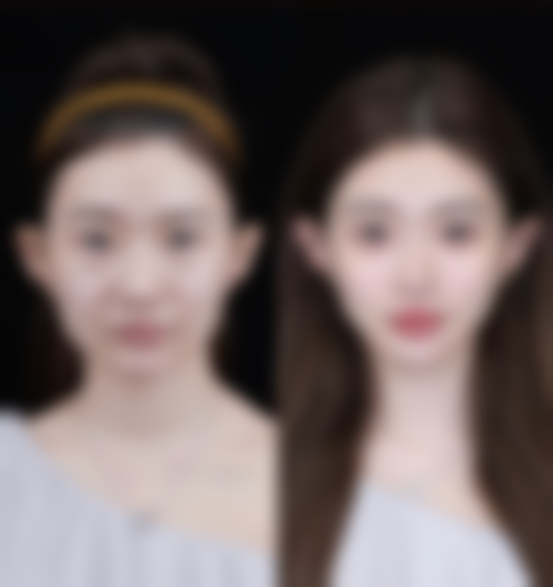 下颚突出如何矫正？揭秘3种有效医美矫正方法，让你轻松拥有精致脸型告别面部缺陷！ 