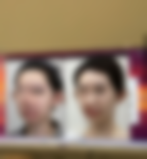 瘦脸针打完多久见效