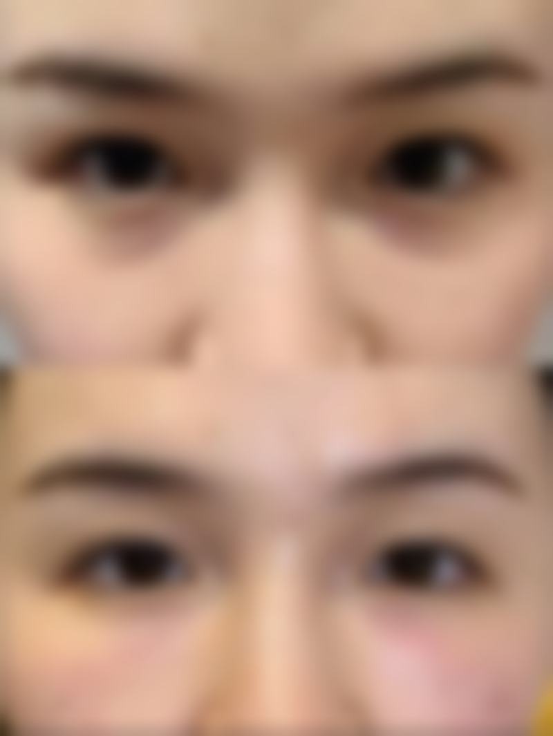 下颚突出如何矫正脸型