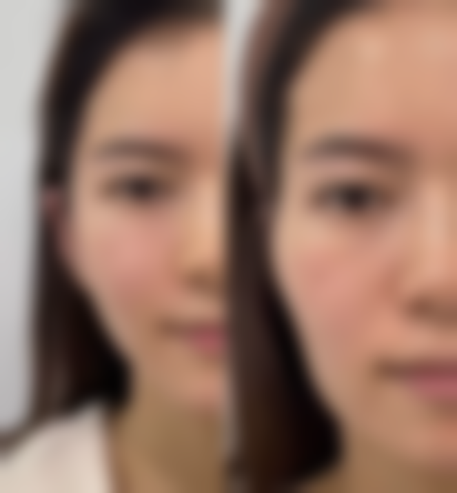 瘦脸针的危害和副作用