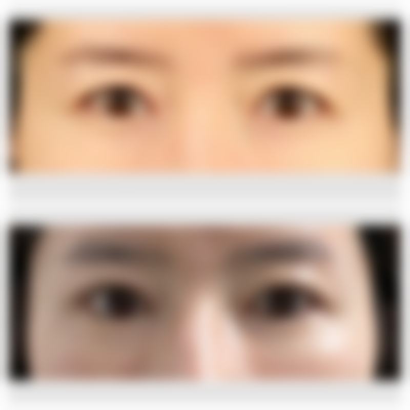 衡力瘦脸针能维持多久