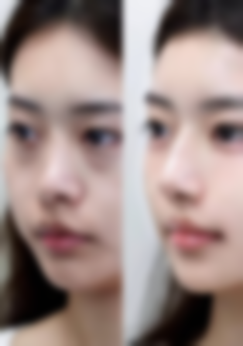 注射衡力瘦脸针的注意事项