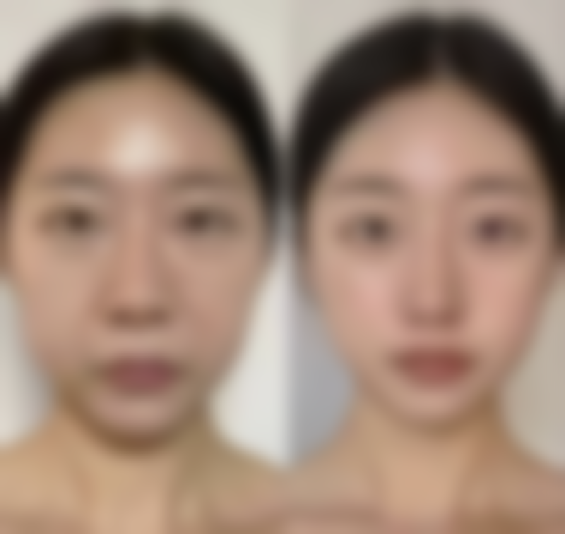 做阴道紧缩手术对身体有副作用吗