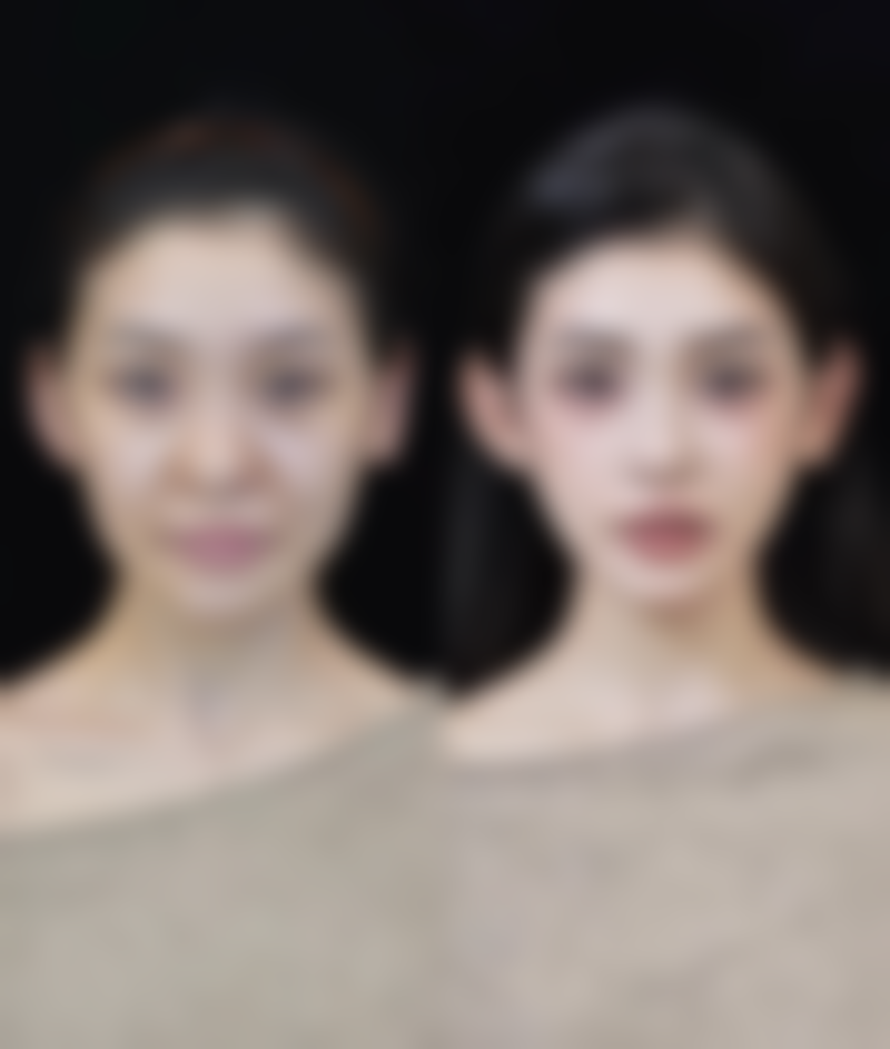 玻尿酸丰太阳穴效果能保持多久？揭秘3种常见玻尿酸保持时长，为你定制持久嘭弹美太阳穴！ 